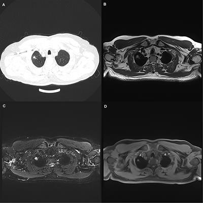 The Application and Value of 3T Magnetic Resonance Imaging in the Display of Pulmonary Nodules